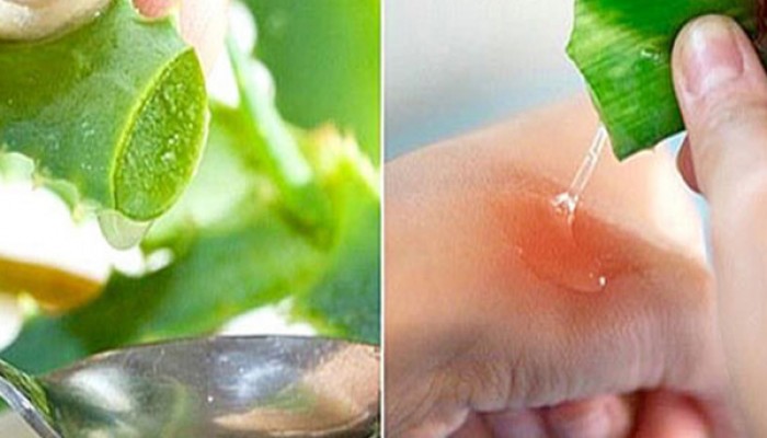10 cách giảm đau rát khi bị bỏng hiệu quả tại nhà