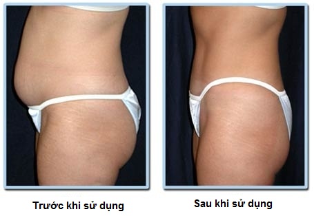 Kem Tan Mỡ Thorakao- Đánh Tan Mỡ Thừa