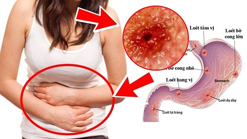 Varogel Là Thuốc Gì, Liều Dùng Và Hướng Dẫn Sử Dụng