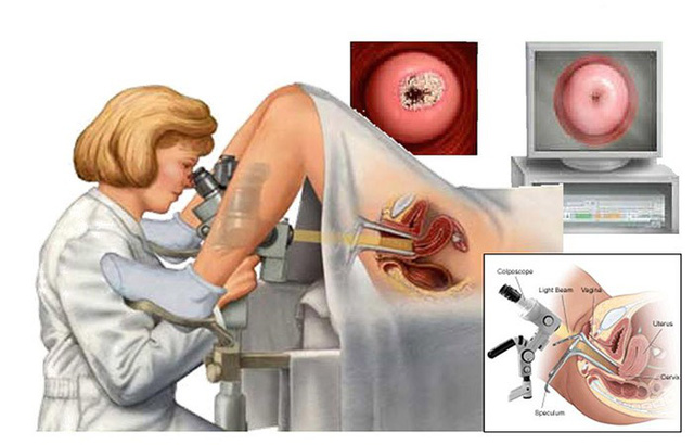 Ung Thư Cổ Tử Cung Là Gì, Có Chết Không, Phương Pháp Điều Trị Hiệu Quả