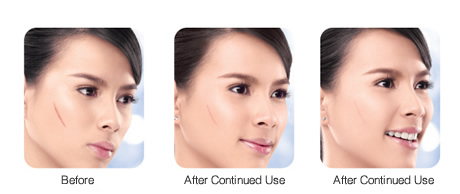 Kem Trị Sẹo DERMATIX Và Những Tác Dụng ‘thần Thánh’ Không Ngờ