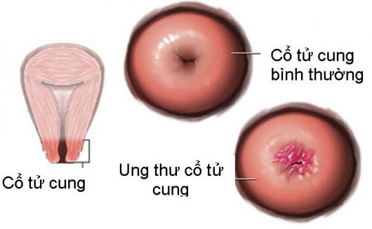 Ung Thư Cổ Tử Cung Là Gì, Có Chết Không, Phương Pháp Điều Trị Hiệu Quả