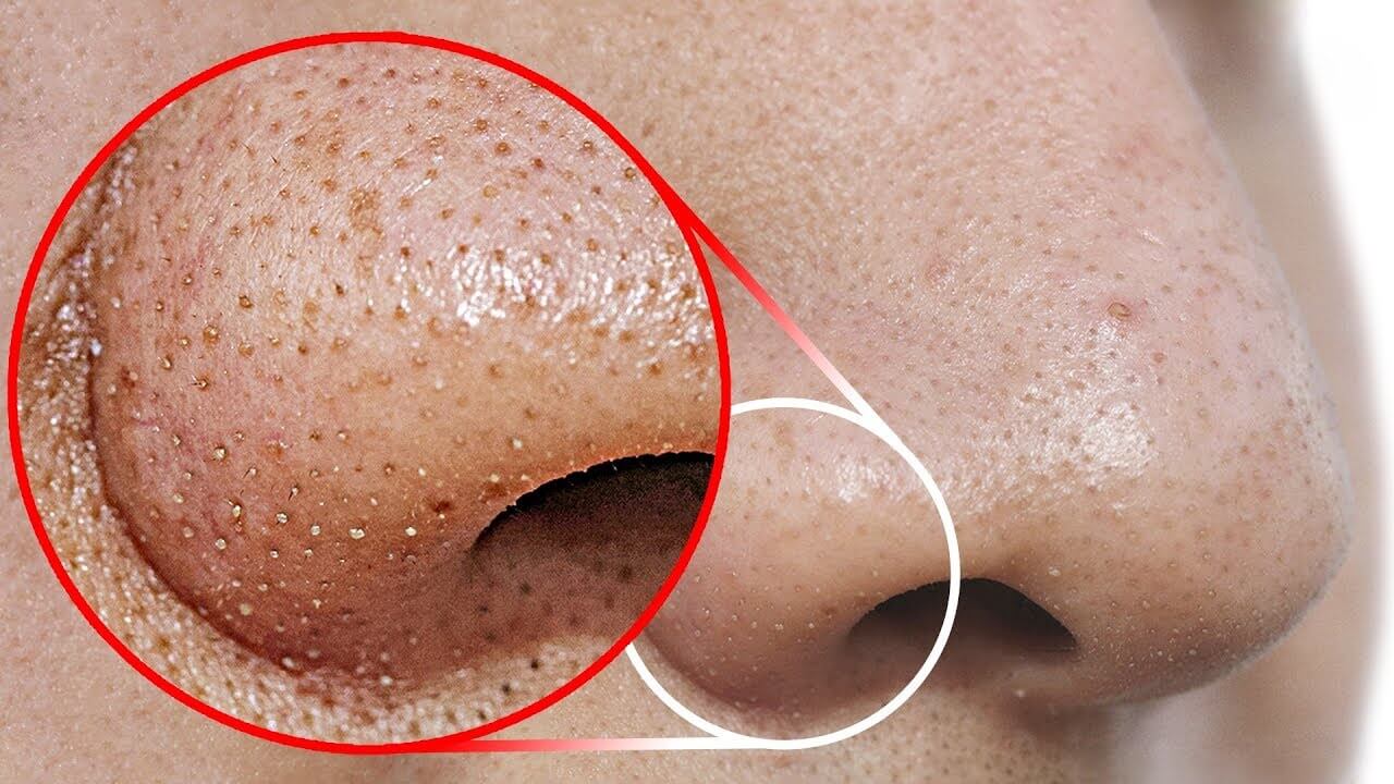Gel Lột Mụn Pore Remodeling Mask Mua Ở Đâu? Cách Sử Dụng Hiệu Quả?