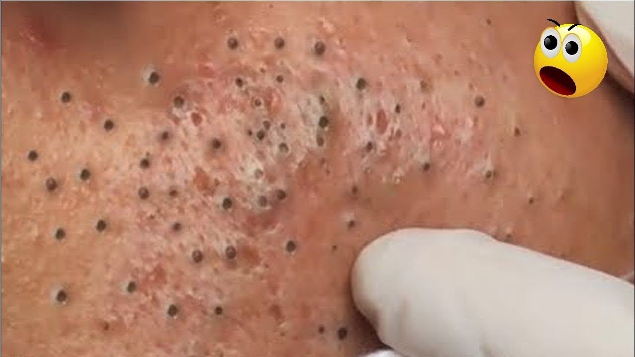Gel Lột Mụn Pore Remodeling Mask Mua Ở Đâu? Cách Sử Dụng Hiệu Quả?