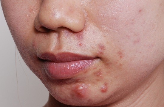 Mụn Trứng Cá Có Mấy Loại, Phương Pháp Điều Trị Nào Hiệu Quả Nhất?