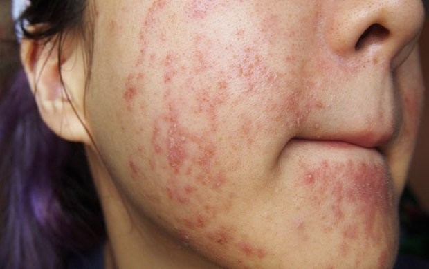 Mụn Trứng Cá Có Mấy Loại, Phương Pháp Điều Trị Nào Hiệu Quả Nhất?