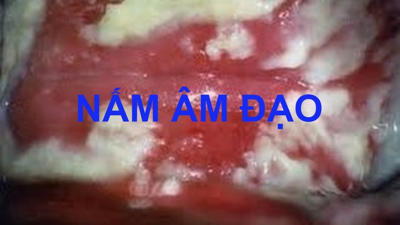 Nấm Âm Đạo: Nguyên Nhân, Biểu Hiện, Và Phương Pháp Điều Trị Hiệu Quả