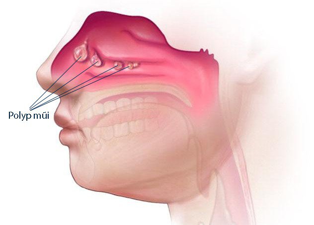 Polyp Mũi: Nguyên Nhân, Biểu Hiện, Phương Pháp Điều Trị Hiệu Quả