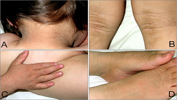 Gai Đen Là Bệnh Gì? Nguyên Nhân, Biểu Hiện, Điều Trị Hiệu Quả?