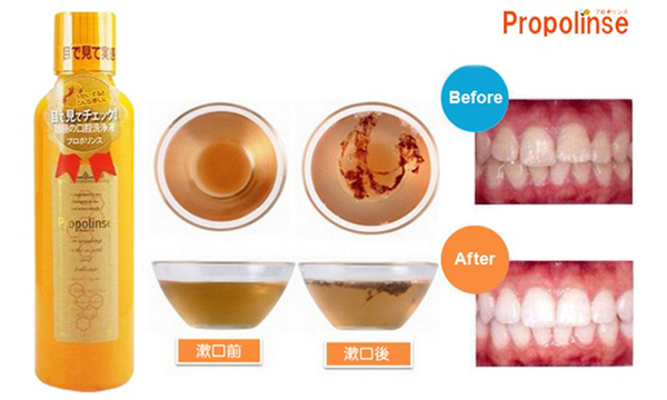 Nước Súc Miệng Propolinse Có Mấy Loại? Người Dùng Họ Review Gì?