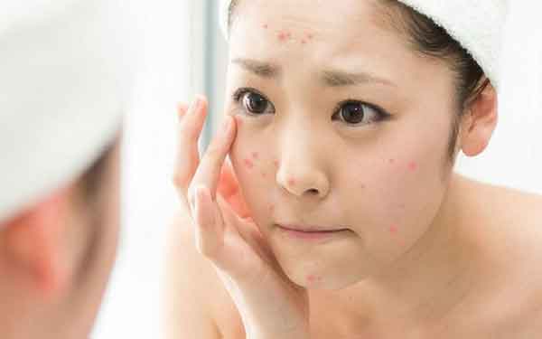 Top 12 Sữa Rửa Mặt Trị Mụn Tốt Được Tin Dùng Nhất Hiện Nay, Có Thể Sử Dụng Cho Cả 4 Mùa